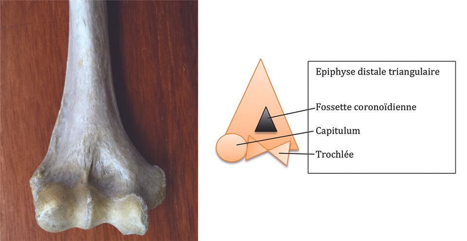 L’ostéosynthèse des fractures de l’humérus distal