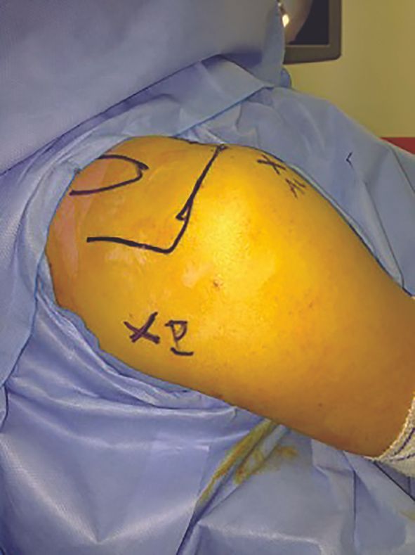 Latarjet-Bankart arthroscopique  avec un ancillaire glénoïdien et coracoïdien  et une fixation par double endo-bouton cortical : Résultats cliniques et scanner des 46 premiers cas