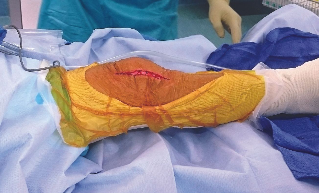 La voie sub vastus latérale pour l’arthroplastie totale du genou : une réadaptation plus rapide