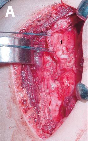 Ostéotomie de centrage de la tête humérale pour le traitement des séquelles de la paralysie obstétricale de l'épaule