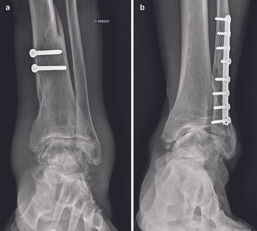 Prothèses totales de cheville : une solution fiable