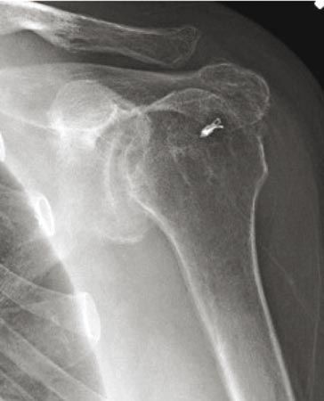 Technique d'arthroplastie par prothèse totale d'épaule inversée "Trabecular Metal"