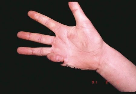 Arthrodèse accourcissant l'auriculaire par ablation de la phalange intermédiaire pour les crochets invétérés de la maladie de Dupuytren