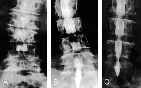 Peut-on ne pas greffer les instrumentations rachidiennes en pathologie lombaire dégénérative ?