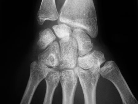 Ostéotomie du capitatum et nécrose du lunatum dans la maladie de Kienbock