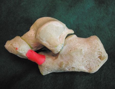 Les "fausses entorses" de l'adolescent