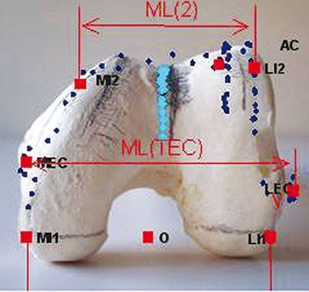 Un dessin français original de prothèse totale de genou