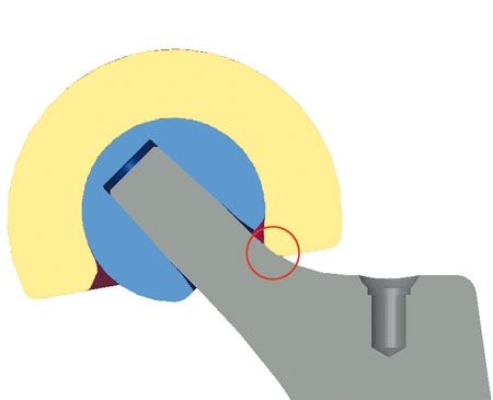 Prothèse totale de hanche à double mobilité et chirurgie mini invasive