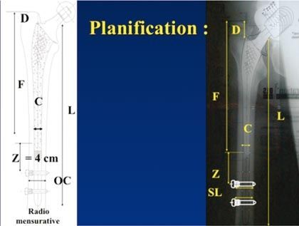 Reprises fémorales par tige verrouillée DLS et fémorotomie