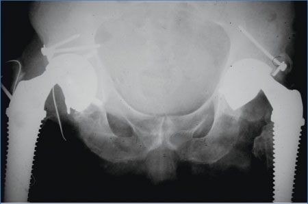 La luxation intra prothétique - une complication rare de la double mobilité