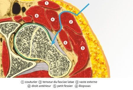 Arthroplastie totale de hanche par voie antérieure de Hueter mini-invasive.
