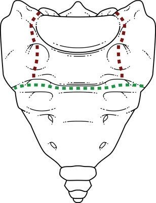 Les fractures transversales hautes du sacrum : notre expérience pour le diagnostic et le traitement