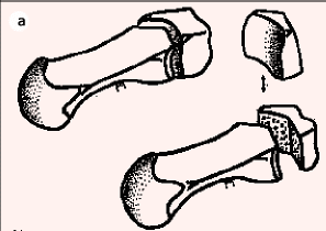 Traitement de la rhizarthrose par la résection partielle du trapèse et autogreffe cartilagineuse costale.