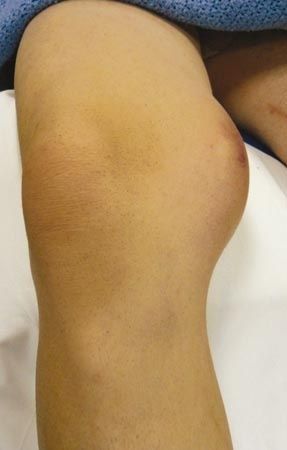 Les tumeurs malignes des parties molles, le chirurgien orthopédiste et l'équipe pluridisciplinaire