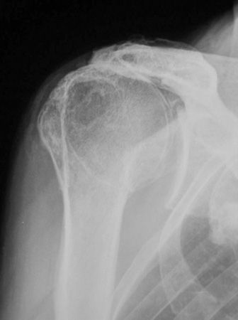 Comment implanter une prothèse d'épaule inversée ?