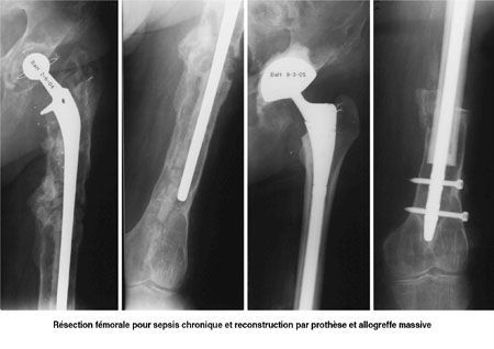 Intérêt d'une banque de tissus en chirurgie orthopédique