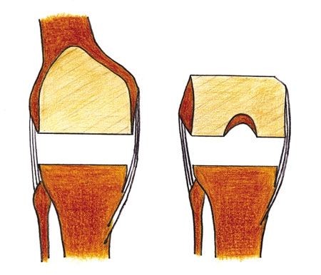 Comment obtenir une amplitude de flexion maximum après une PTG