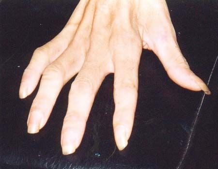Traitement palliatif des paralysies intrinsèques des doigts longs