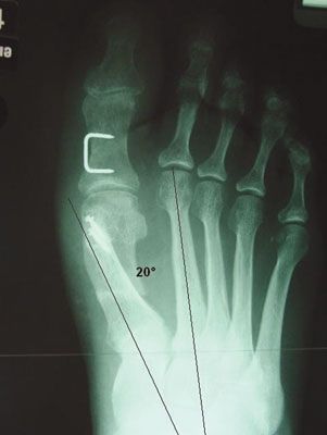Réflexions autour de la chirurgie percutanée de l'hallux valgus