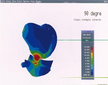La prothèse de genou Rocc-Vanguard