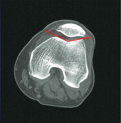 Différences anatomiques homme-femme au niveau de l'extrêmité distale du fémur et applications cliniques.