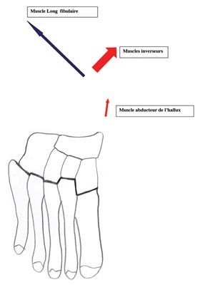 Traitement de l'adduction de l'avant pied chez l'enfant