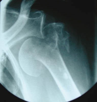 Arthroplastie inversée de grammont en traumatologie fraîche gériatrique