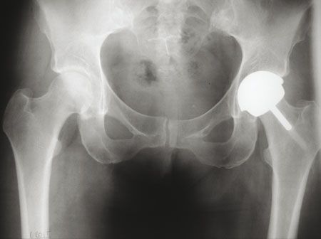 Le resurfaçage total de la hanche : retour du passé ou arthroplastie moderne ?