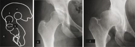 La maladie luxante de la hanche chez l'adulte : classification, indications chirurgicales, technique de la butée de Lance par voie minimale invasive