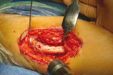 Ostéosynthèse du fémur proximal de l'enfant par plaque LCP