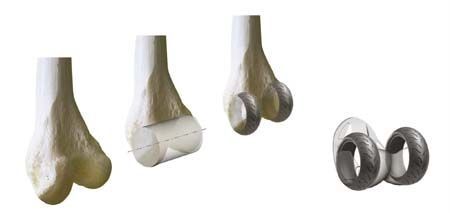 Conception de prothèse de genou à plateau mobile : Evolution vers des surfaces de contact optimales et vers une bonne stabilité antéro-postérieure.