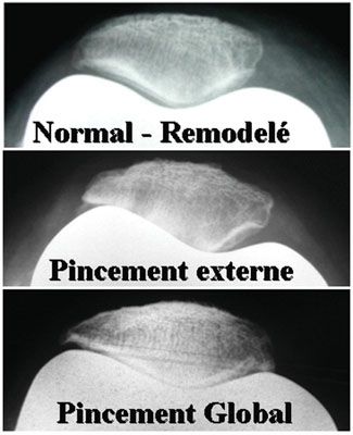 Prothèses du genou et système extenseur - 2ème Journées Lyonnaises de Chirurgie du Genou