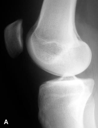 Prise en charge actuelle des luxations épisodiques de la rotule (place de la reconstruction du ligament fémoro-patellaire médial)