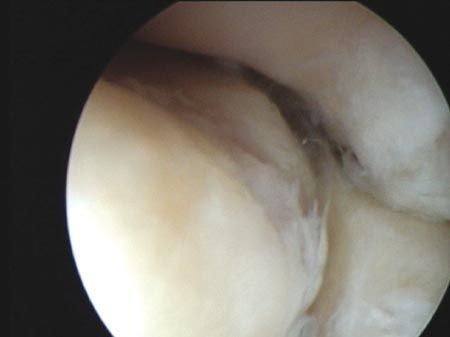 Traitement arthroscopique de l'épicondylite latérale (tennis elbow)