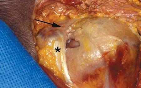 Examen clinique de l'épaule dans la pathologie de la coiffe des rotateurs