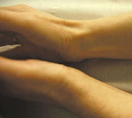 Le scaphoïde : de la fracture à l'arthrose. Nice 30 septembre et 1er octobre 2004