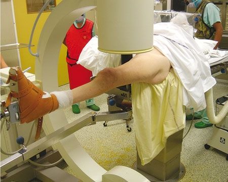 Artifices techniques d’aide à la réduction, dans le traitement des fractures du membre inférieur par plaque à vis bloquées par voie d’abord mini invasive.