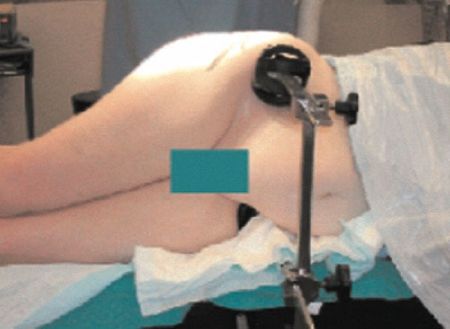 Mise en place de la prothèse totale de hanche exeter par mini abord postéro externe