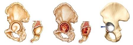 Indication de la prothèse totale de hanche double mobilité - une gamme complète d'implants, adaptée à chaque situation