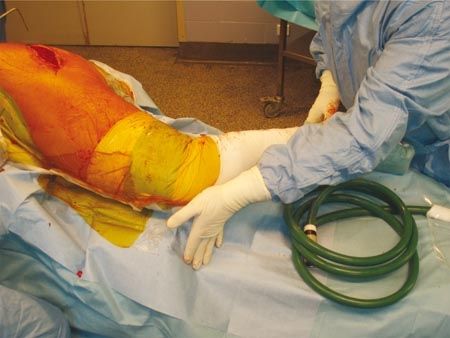 Optimisation de la pose de la prothèse totale de hanche par le dispositif de vérification de longueur et de latéralisation (DVLL)