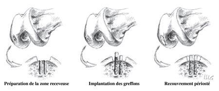 Mosaicplastie associée à un apport périosté dans le traitement des pertes de substances ostéochondrales du genou