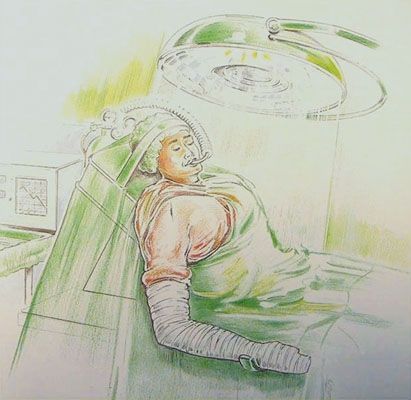 Comment je scelle un implant gléoïdien en polyéthylène convexe à quille avec ma technique de compaction d'os spongieux