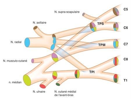 Paralysie du plexus bracchial de l'adulte : Stratégies actuelles