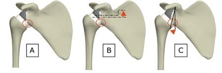 Implant inversé Scultra II, particularité de conception et étude préliminaire