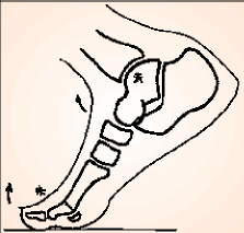 L'arthrodèse de la première articulation métatarso-phalangienne