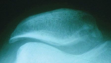 Technique opératoire des prothèses fémoro-patellaires