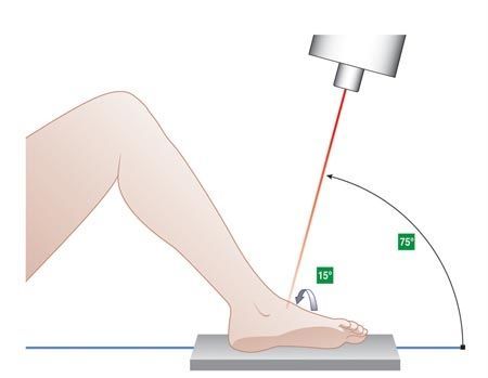 Les fractures du talus