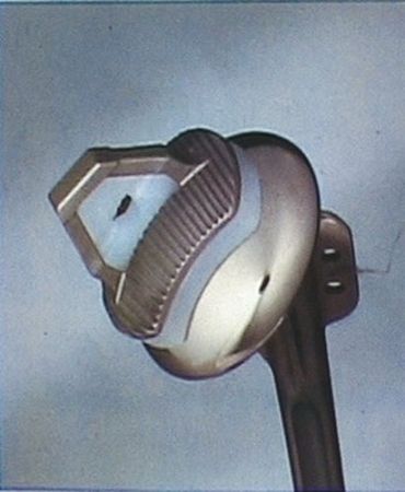 Plaidoyer en faveur du concept d'embase glénoïdienne métallique dans les prothèses totales anatomiques d'épaule