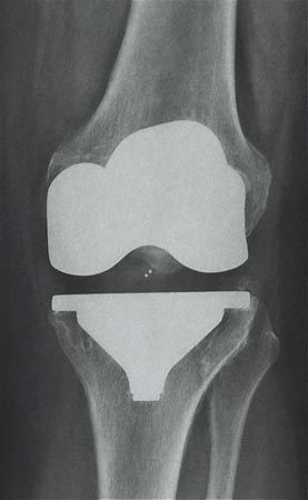 Que penser des nouvelles solutions de programmation personnalisée pour l'implantation d'une prothèse totales de genou ? Réelle avancée technologique ou simple démarche commerciale ?