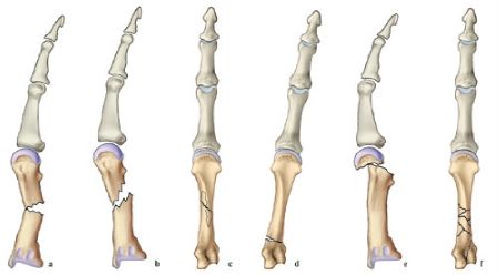 Les techniques chirurgicales du traitement des fractures extra-articulaires des métacarpiens chez l'adulte